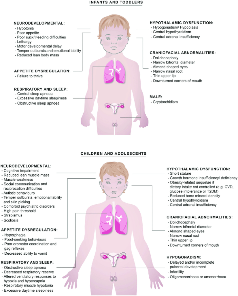 What Is Prader Willi Syndrome AnthosHouse